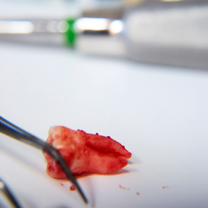 teeth-remove