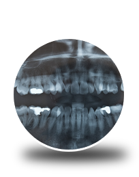 Wisdom Teeth Dentistry